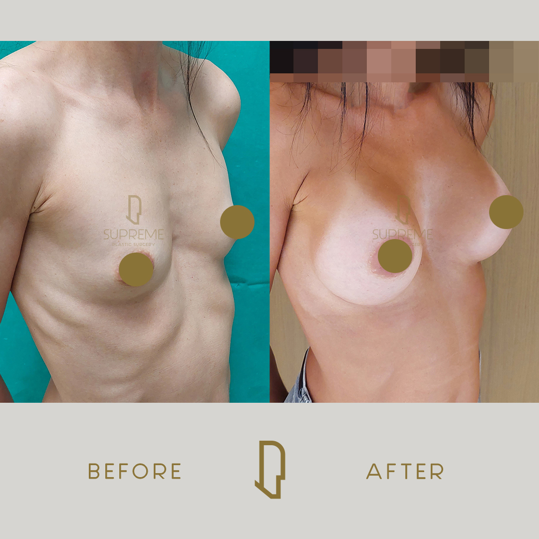 Αυξητική Στήθους