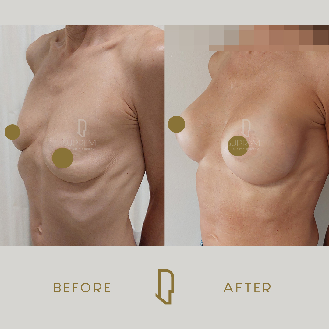 Αυξητική Στήθους