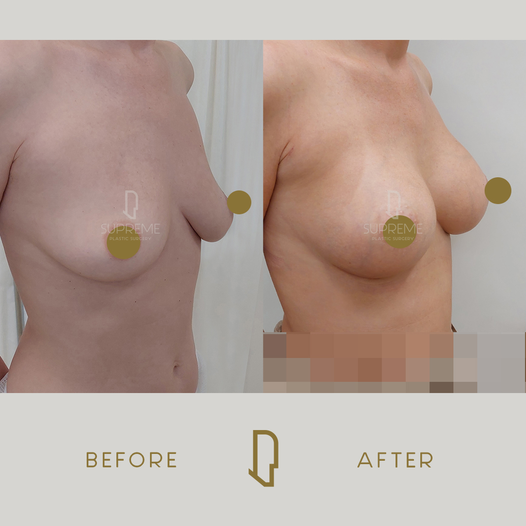 Αυξητική Στήθους