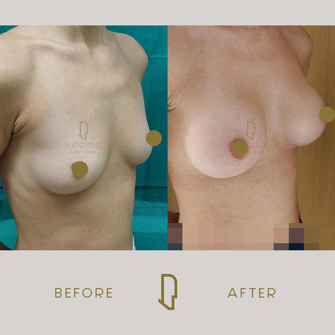 Αυξητική Στήθους