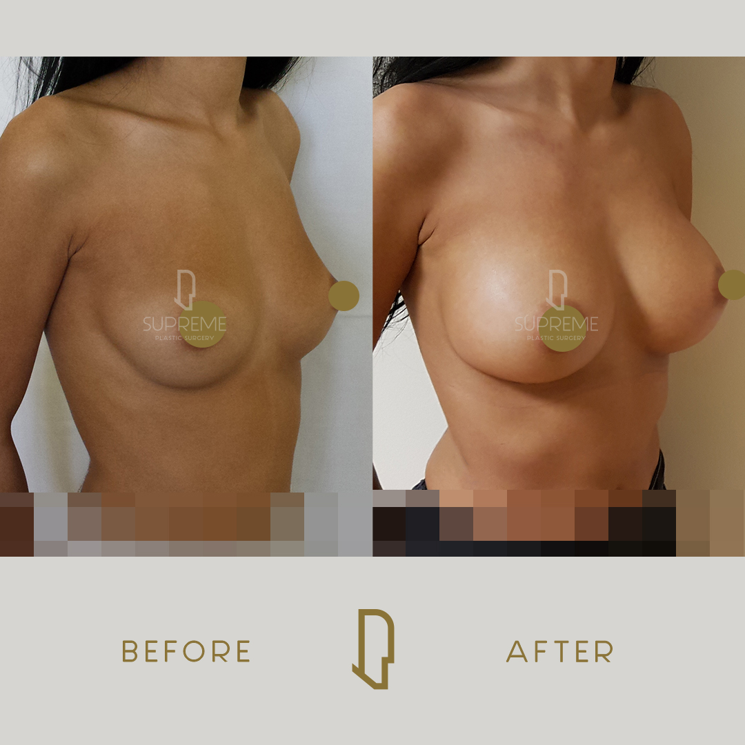 Αυξητική Στήθους