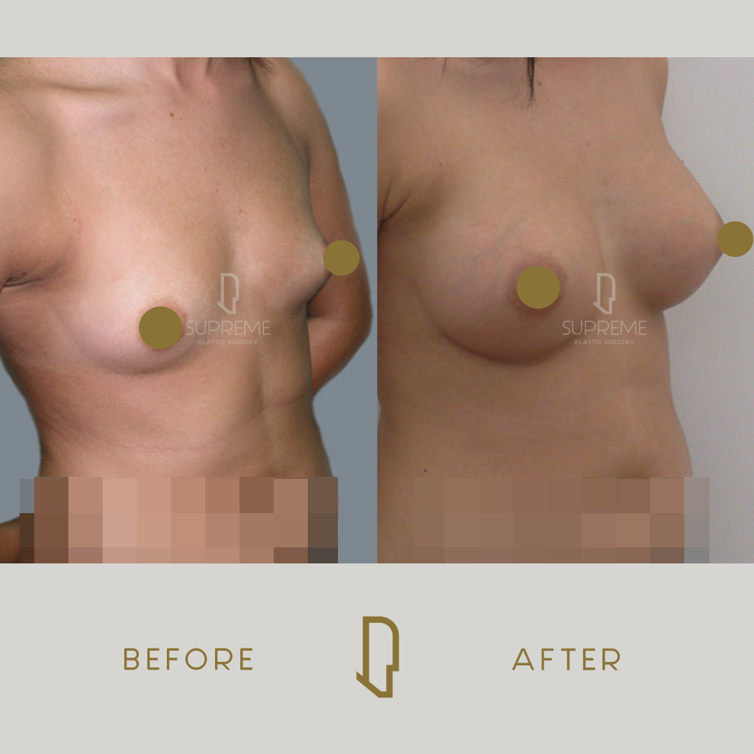 Αυξητική Στήθους