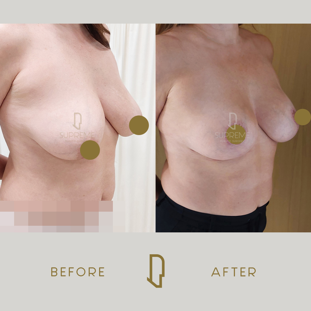 Ανόρθωση μαστών με ένθεμα