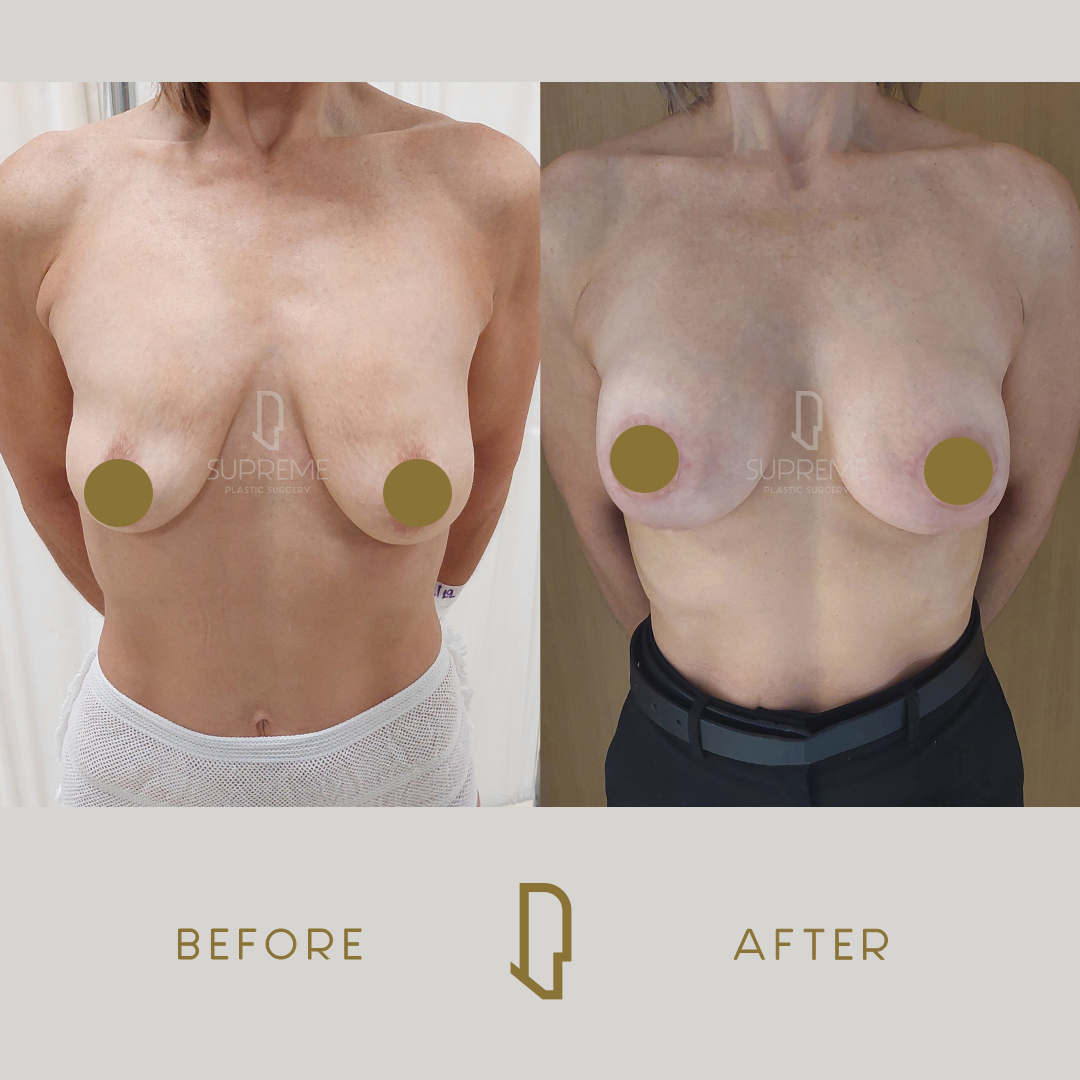 Ανόρθωση μαστών με ένθεμα