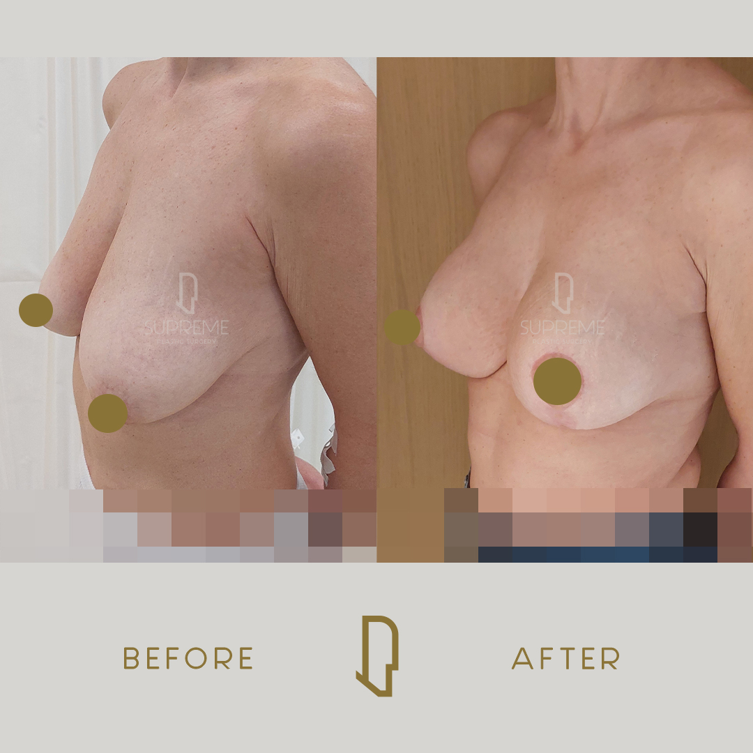 Ανόρθωση μαστών με ένθεμα