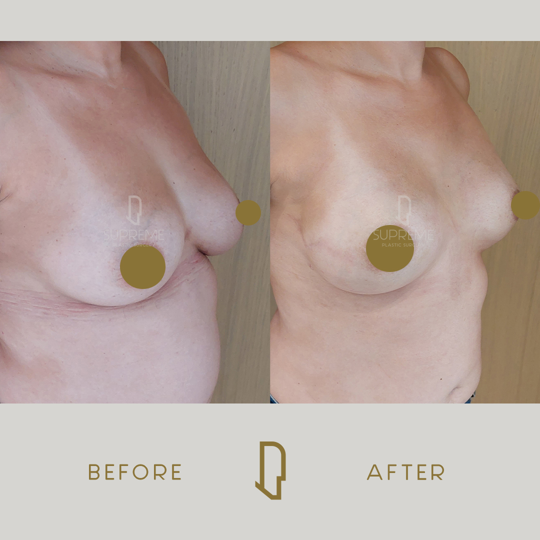 Αποκατάσταση Μαστού Μετά από Μαστεκτομή