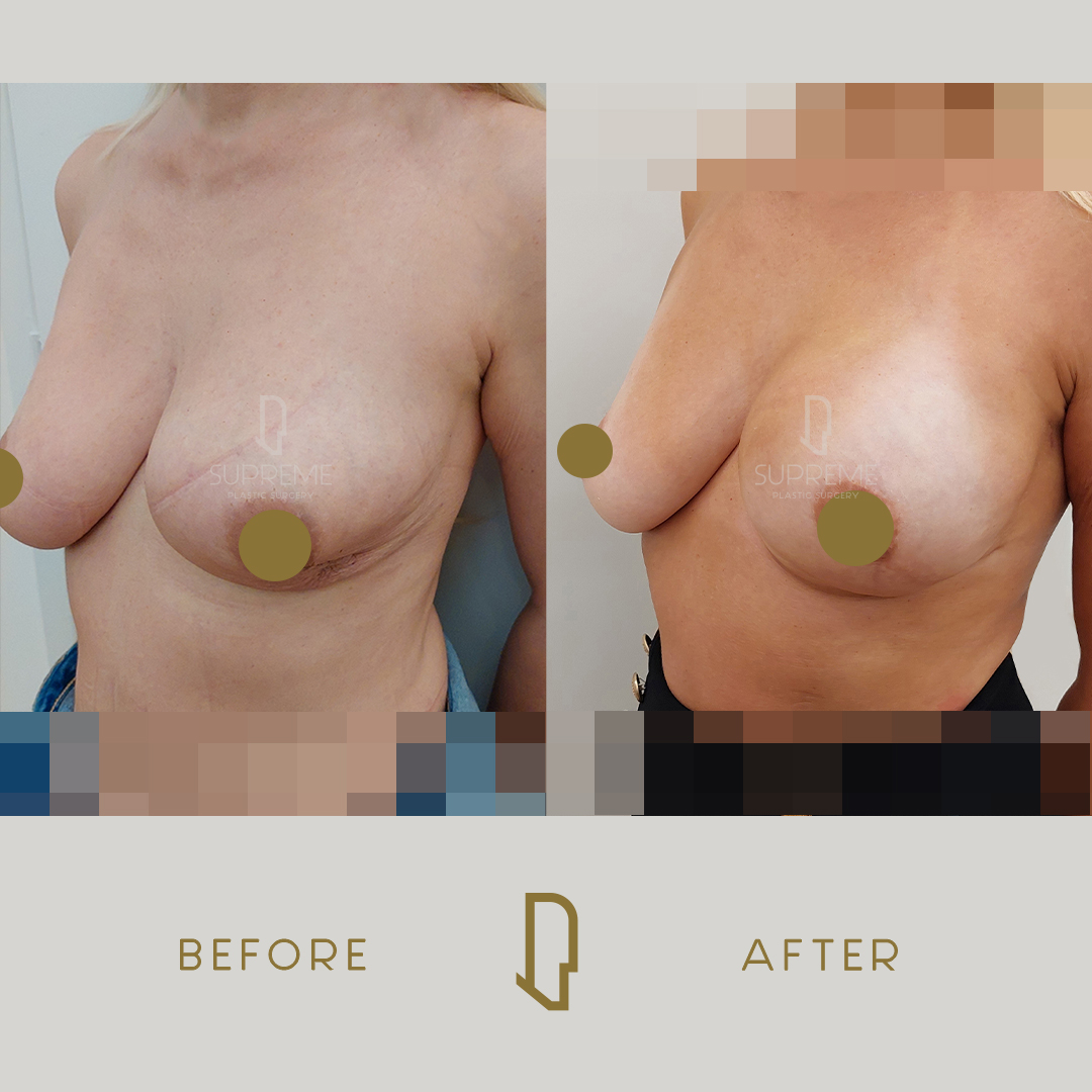 Αποκατάσταση Μαστού Μετά από Μαστεκτομή