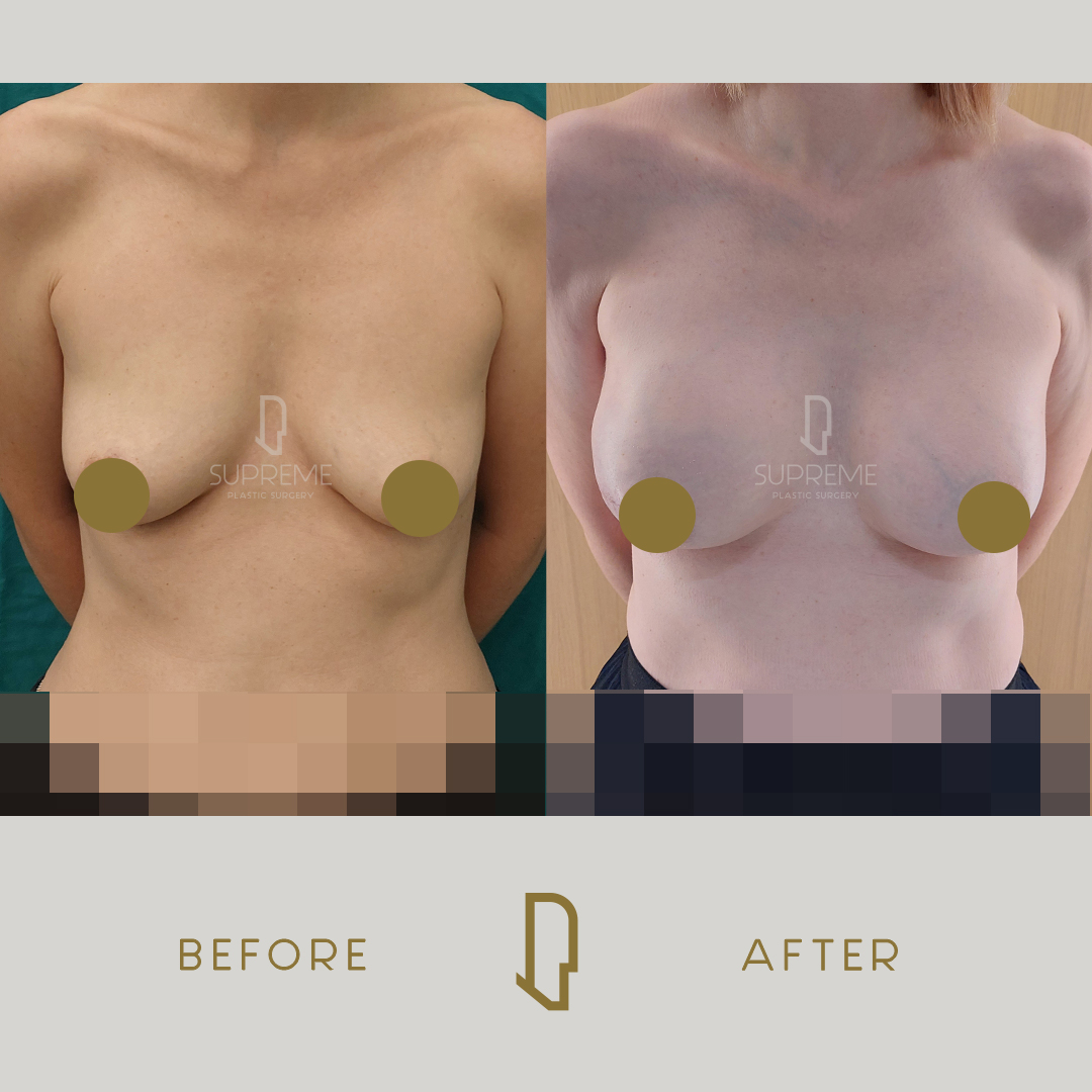 Αποκατάσταση Μαστού Μετά από Μαστεκτομή