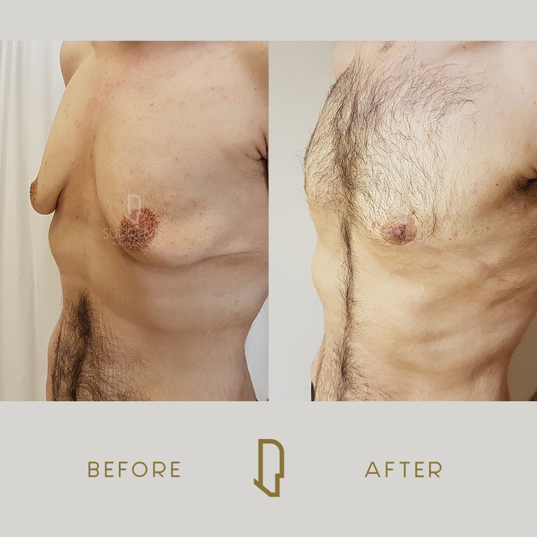 Γυναικομαστία