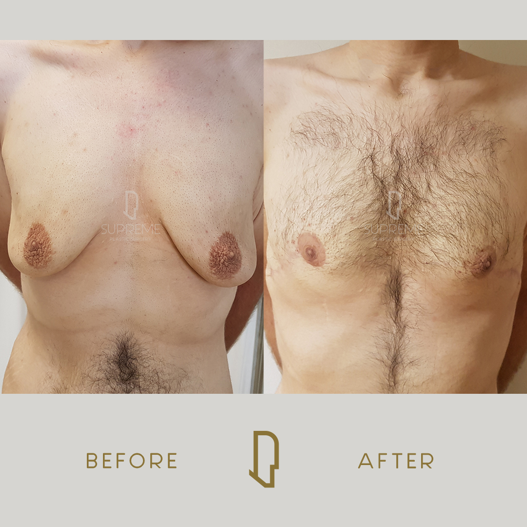 Γυναικομαστία