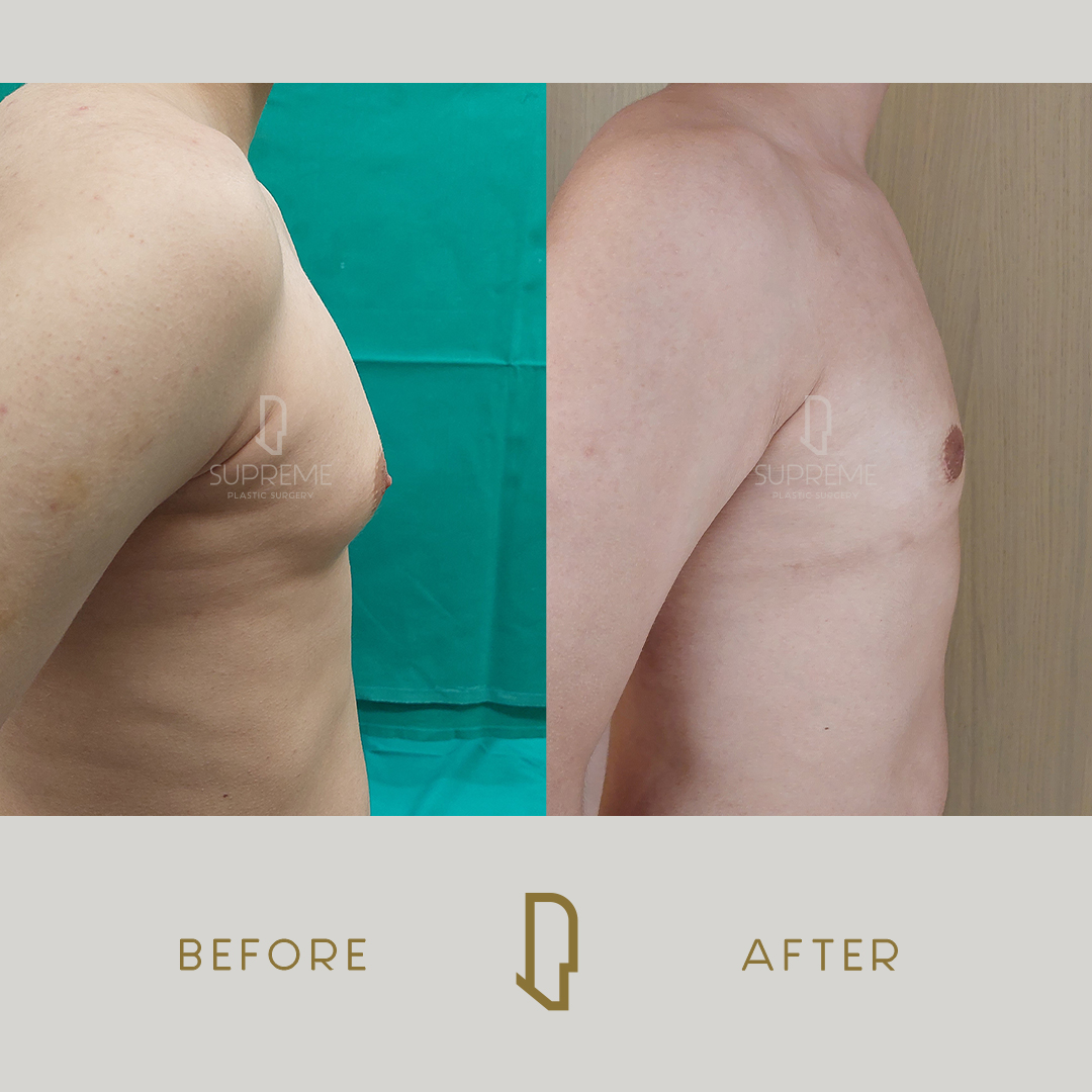 Γυναικομαστία