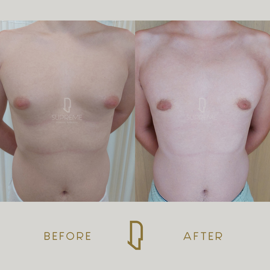 Γυναικομαστία