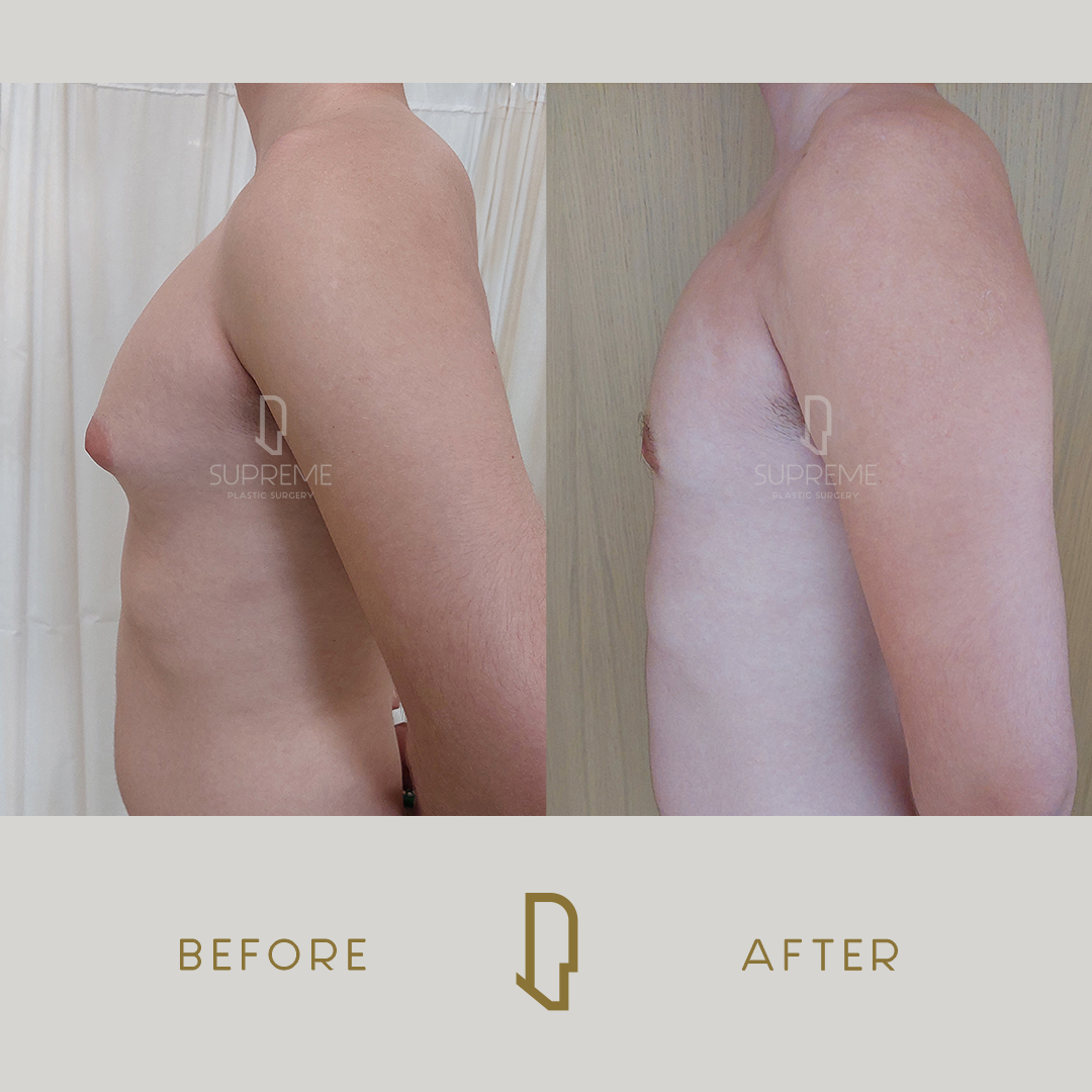 Γυναικομαστία