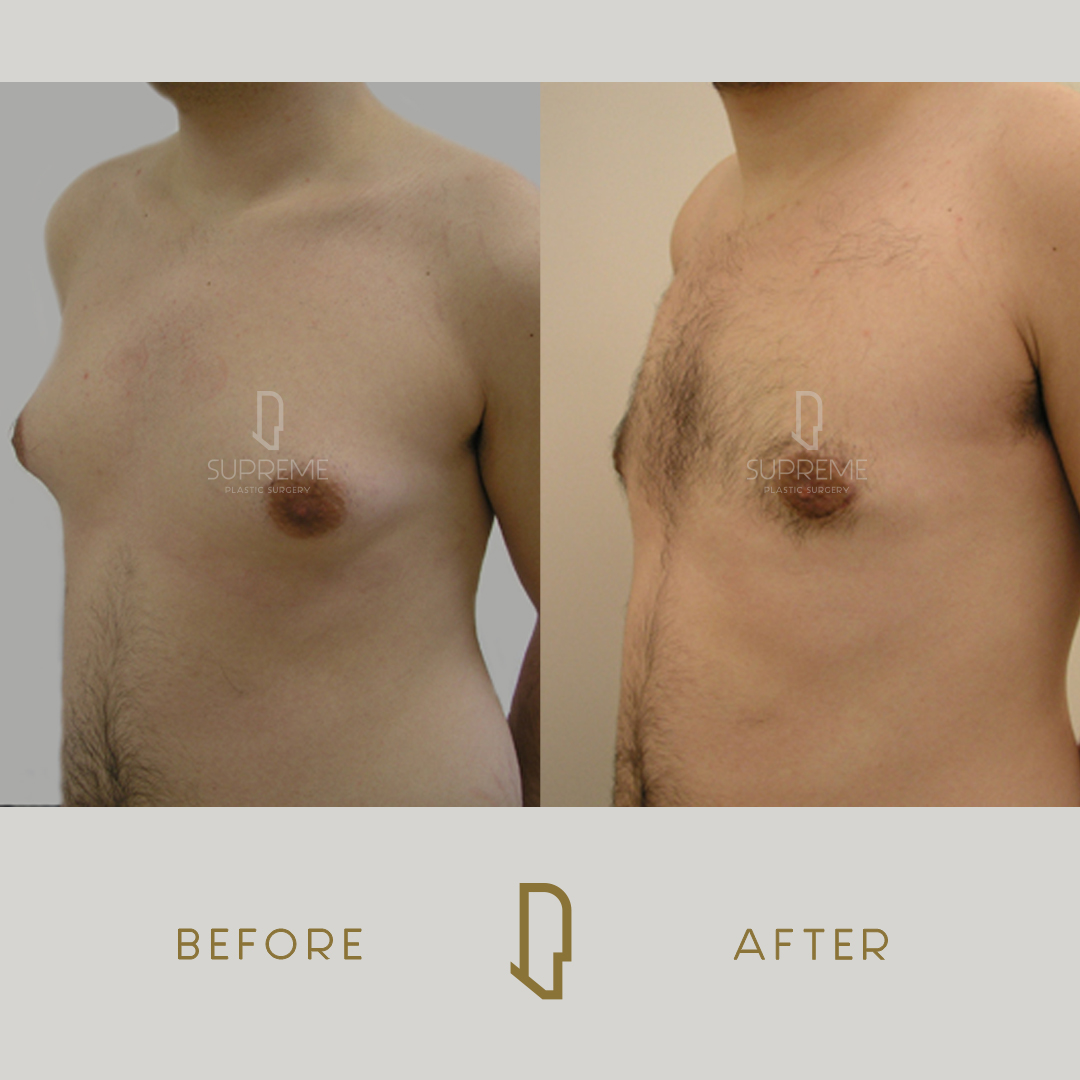 Γυναικομαστία