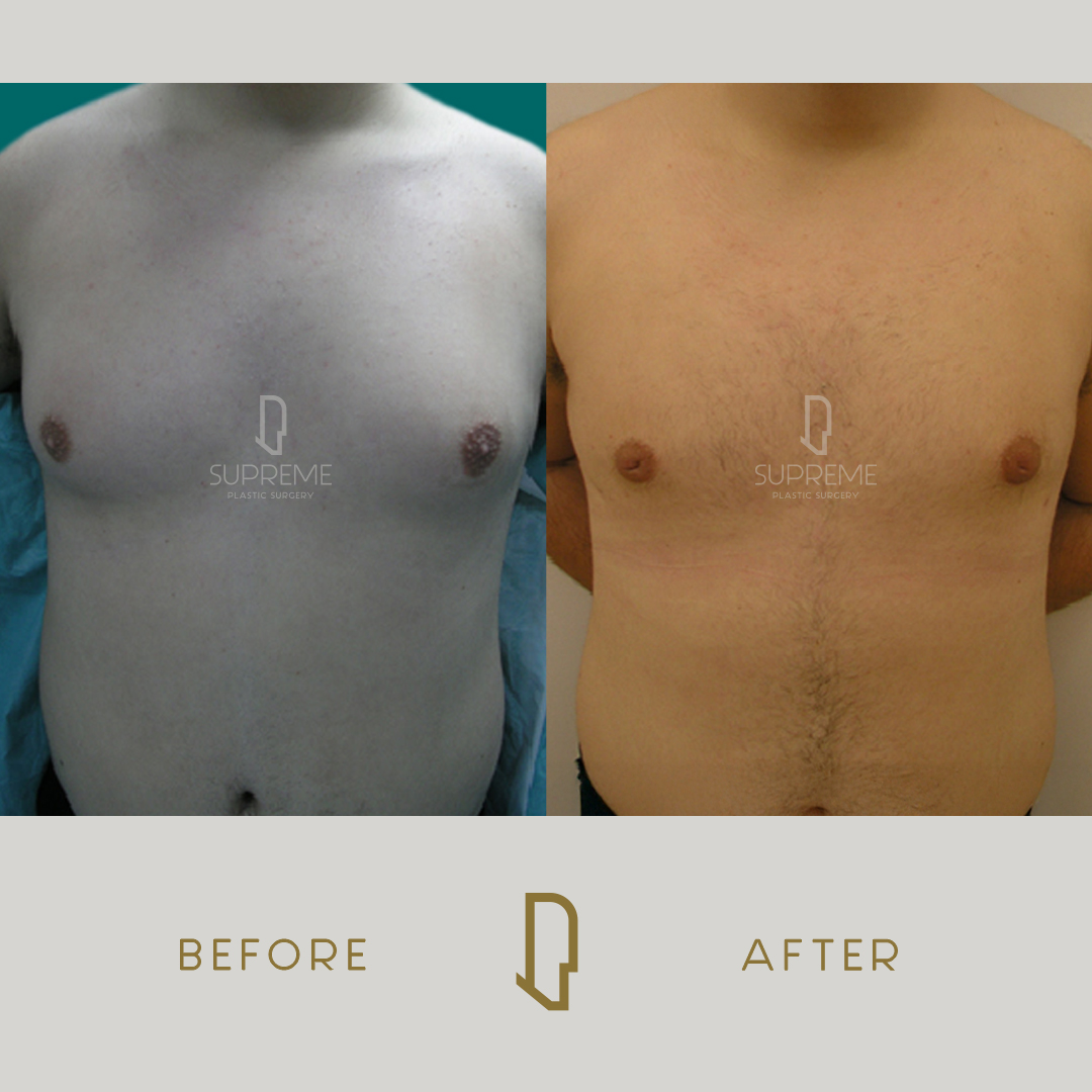 Γυναικομαστία