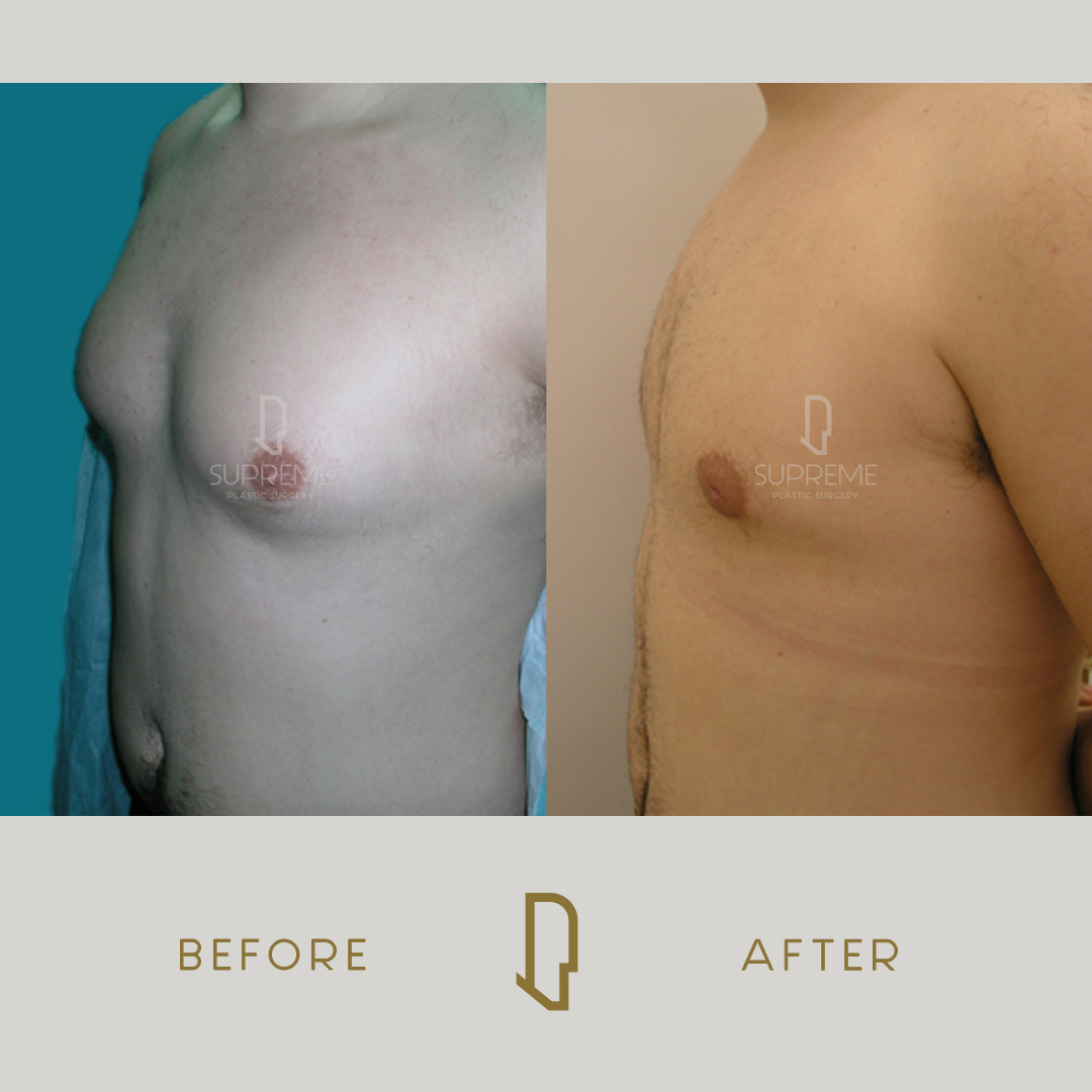 Γυναικομαστία