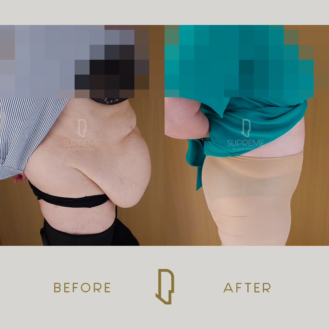 Κοιλιοπλαστική