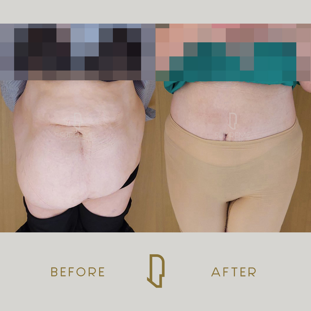 Κοιλιοπλαστική