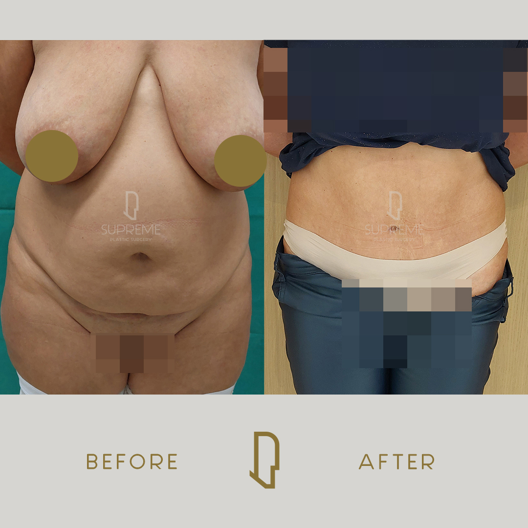 Κοιλιοπλαστική