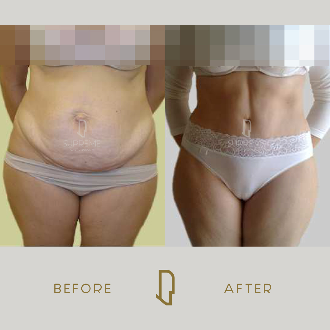 Κοιλιοπλαστική