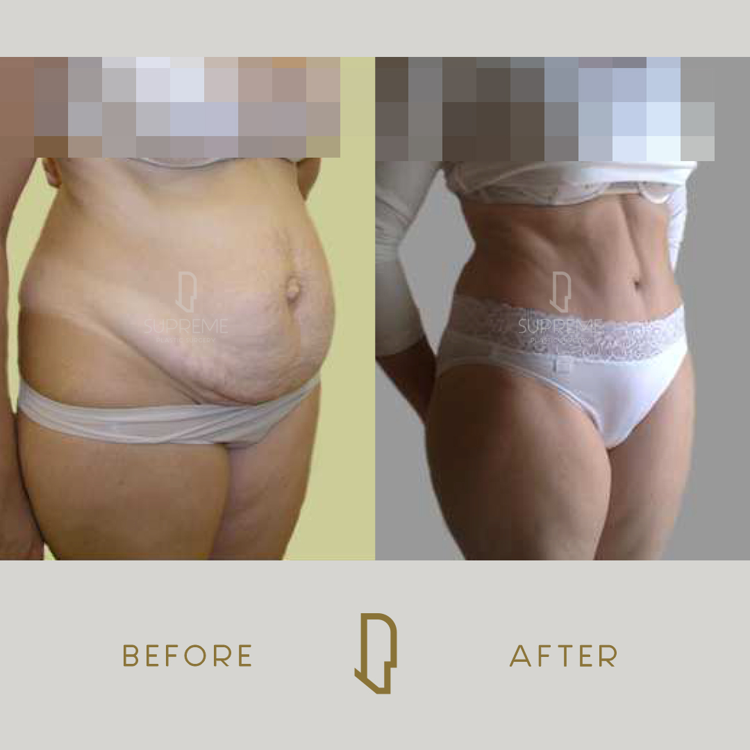 Κοιλιοπλαστική