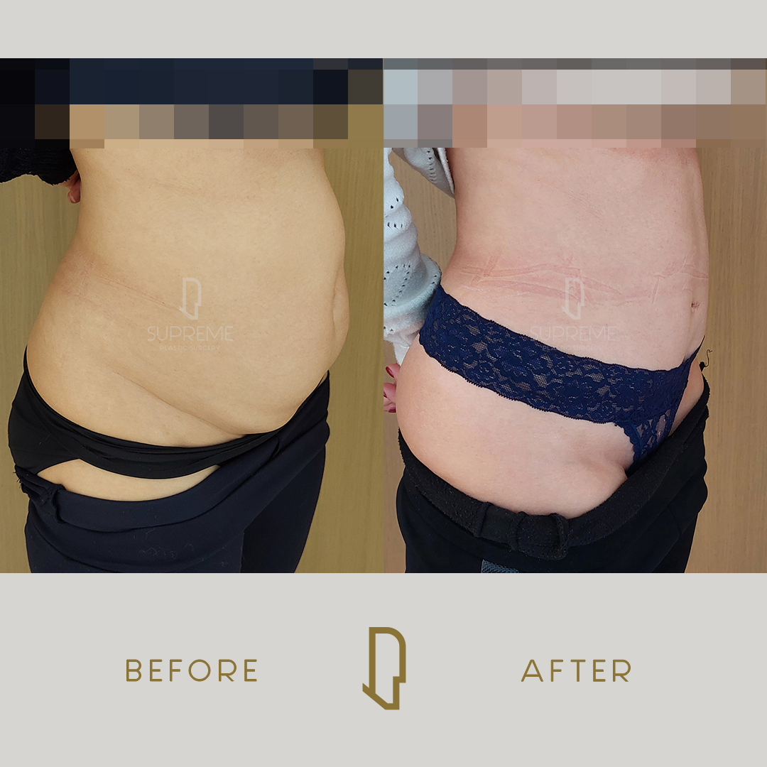 Κοιλιοπλαστική