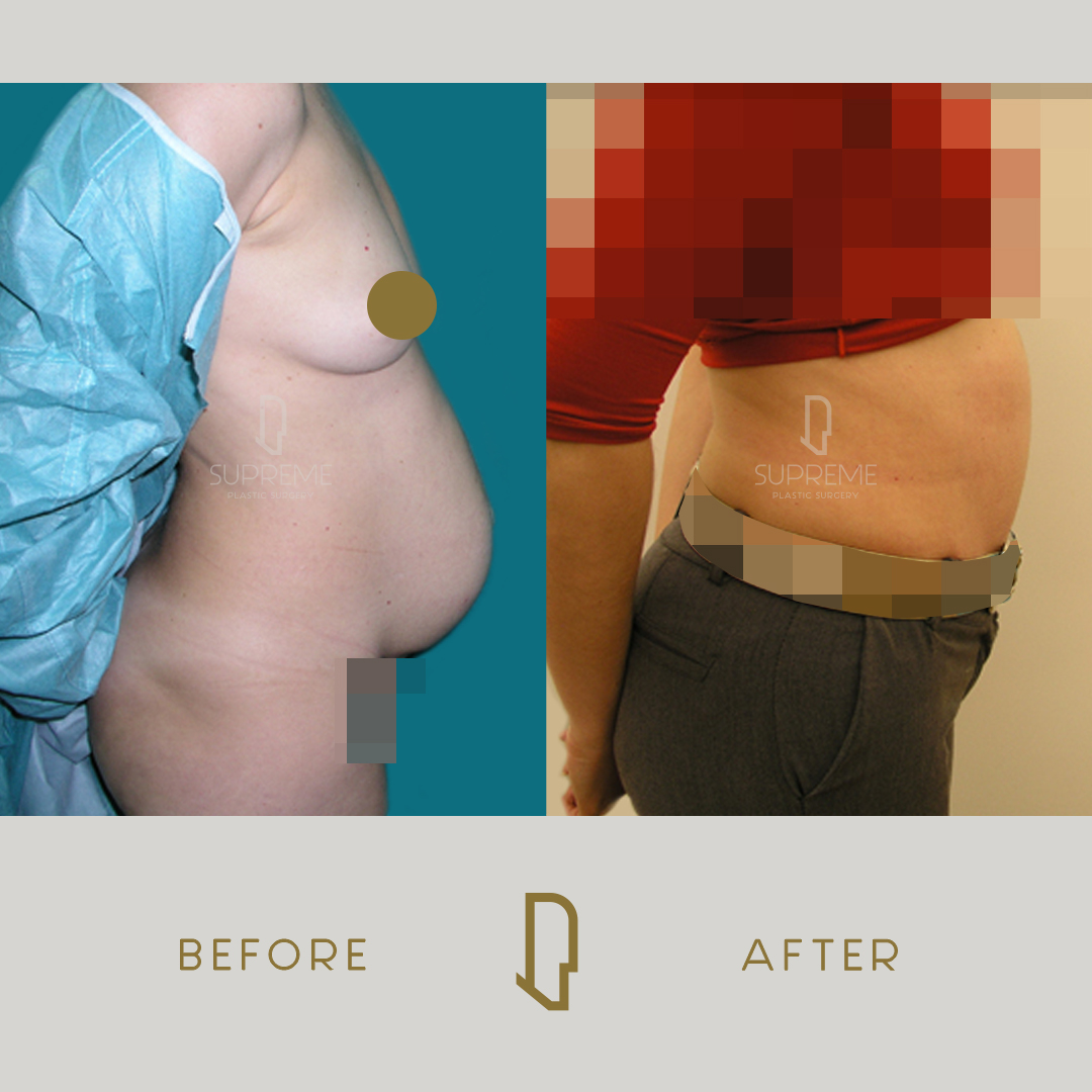 Κοιλιοπλαστική