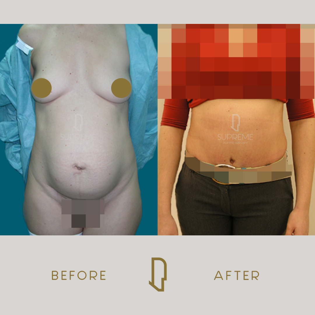 Κοιλιοπλαστική