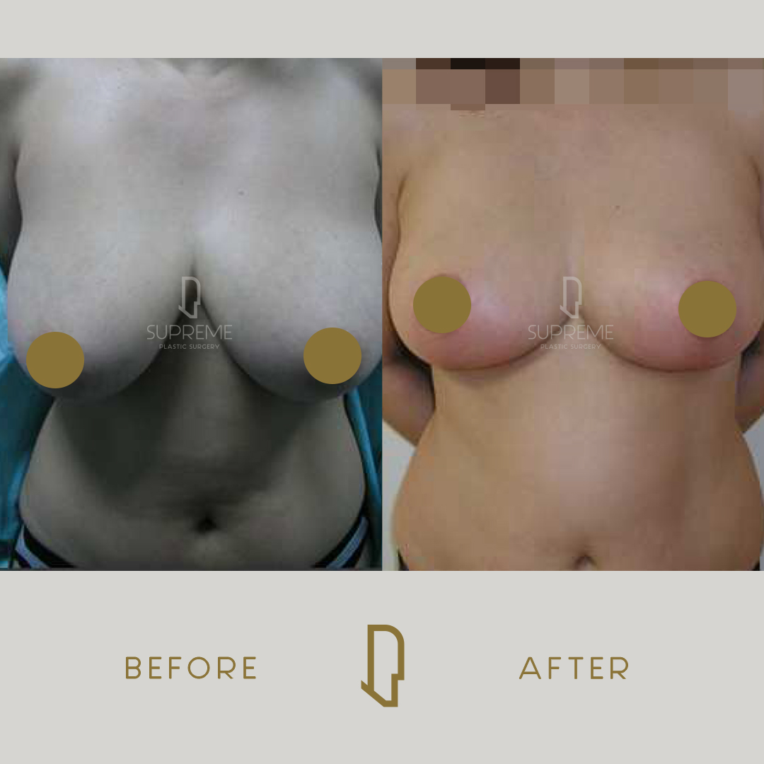 Μειωτική Στήθους