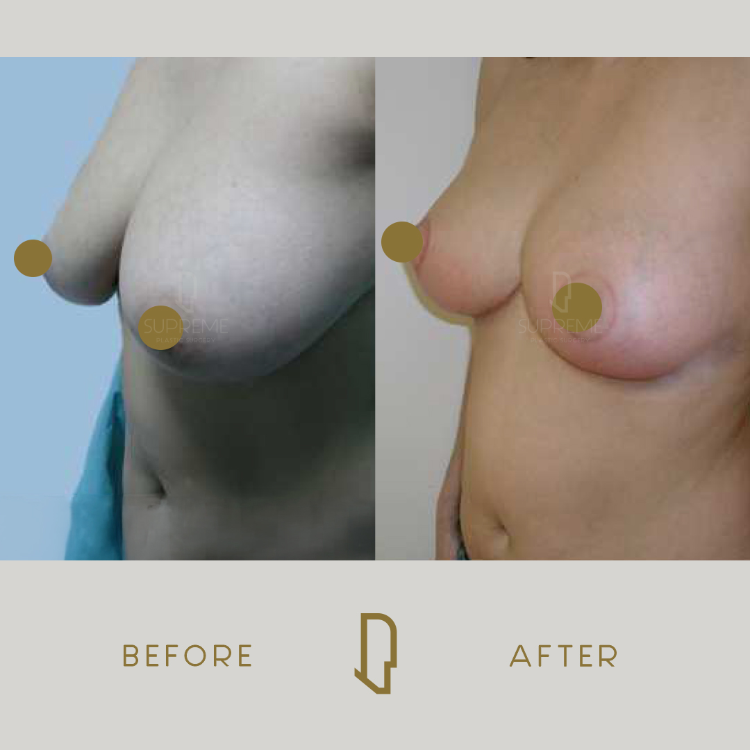 Μειωτική Στήθους