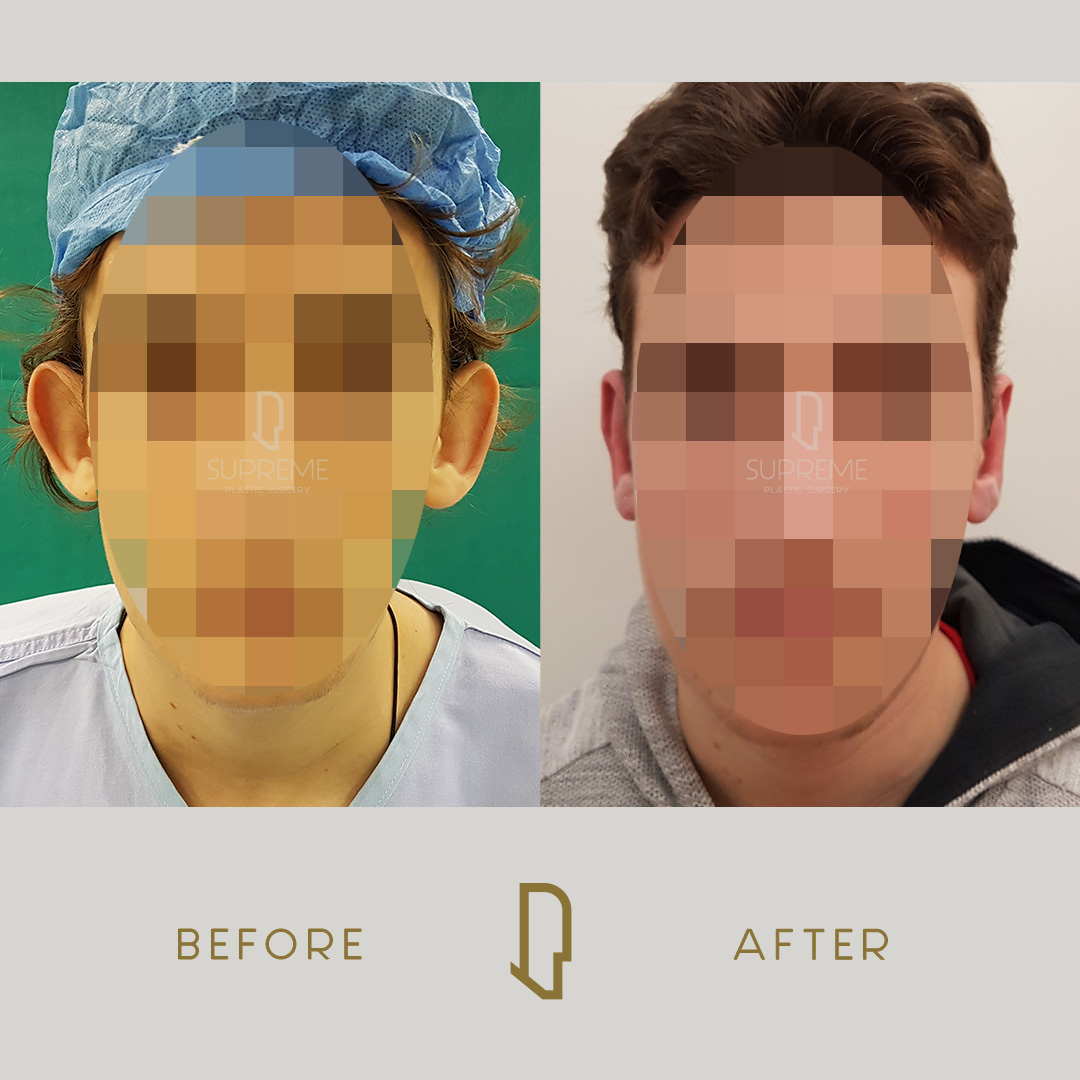 Ωτοπλαστική