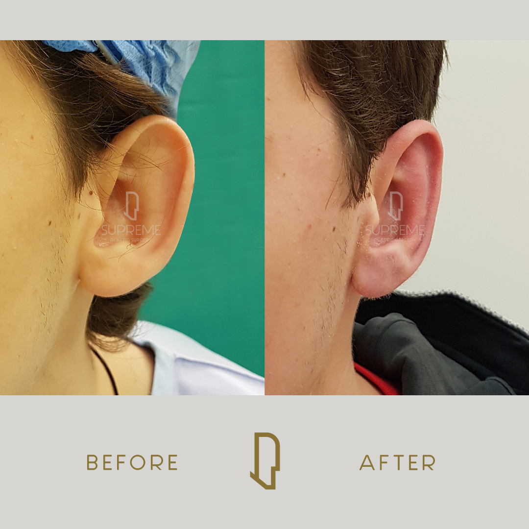 Ωτοπλαστική