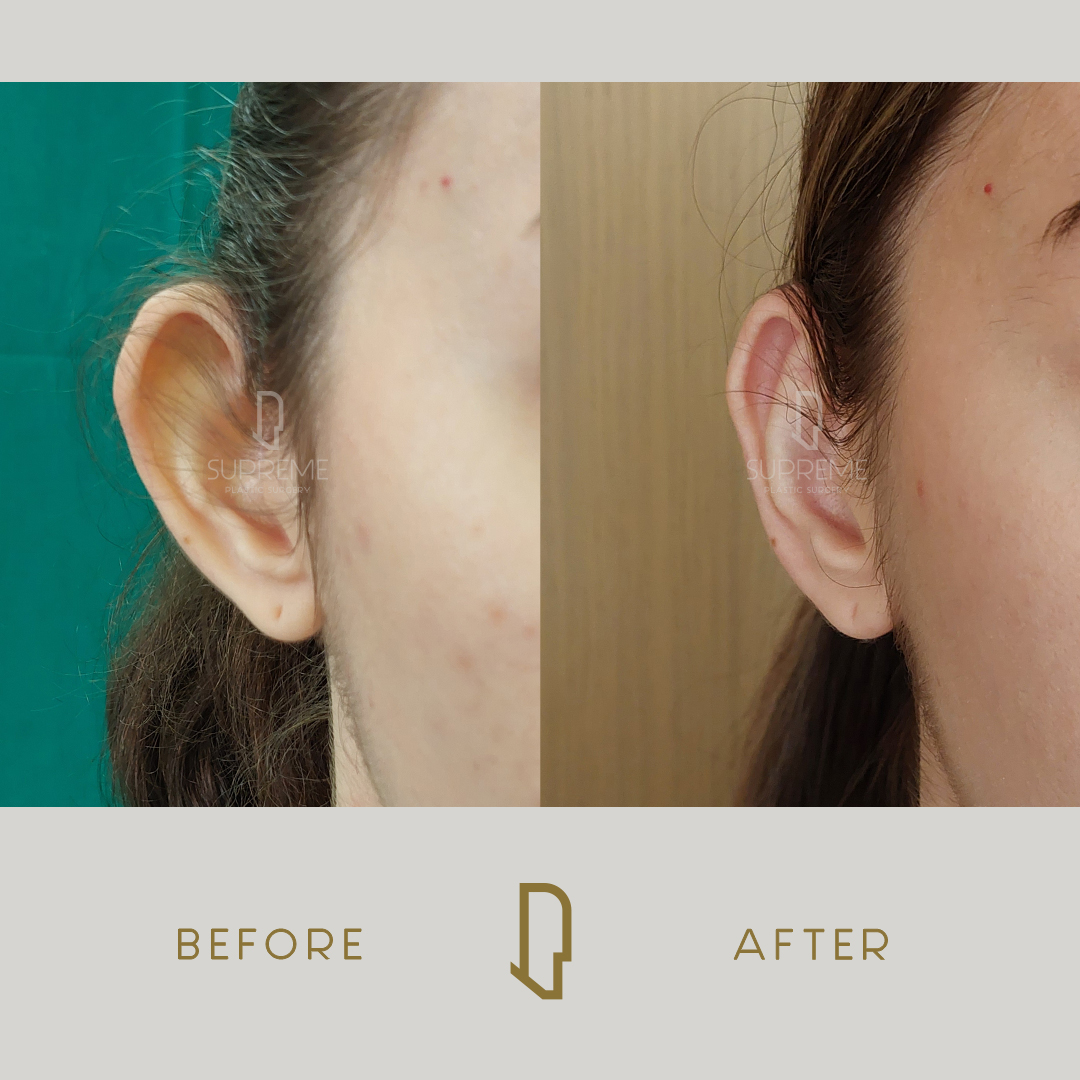 Ωτοπλαστική