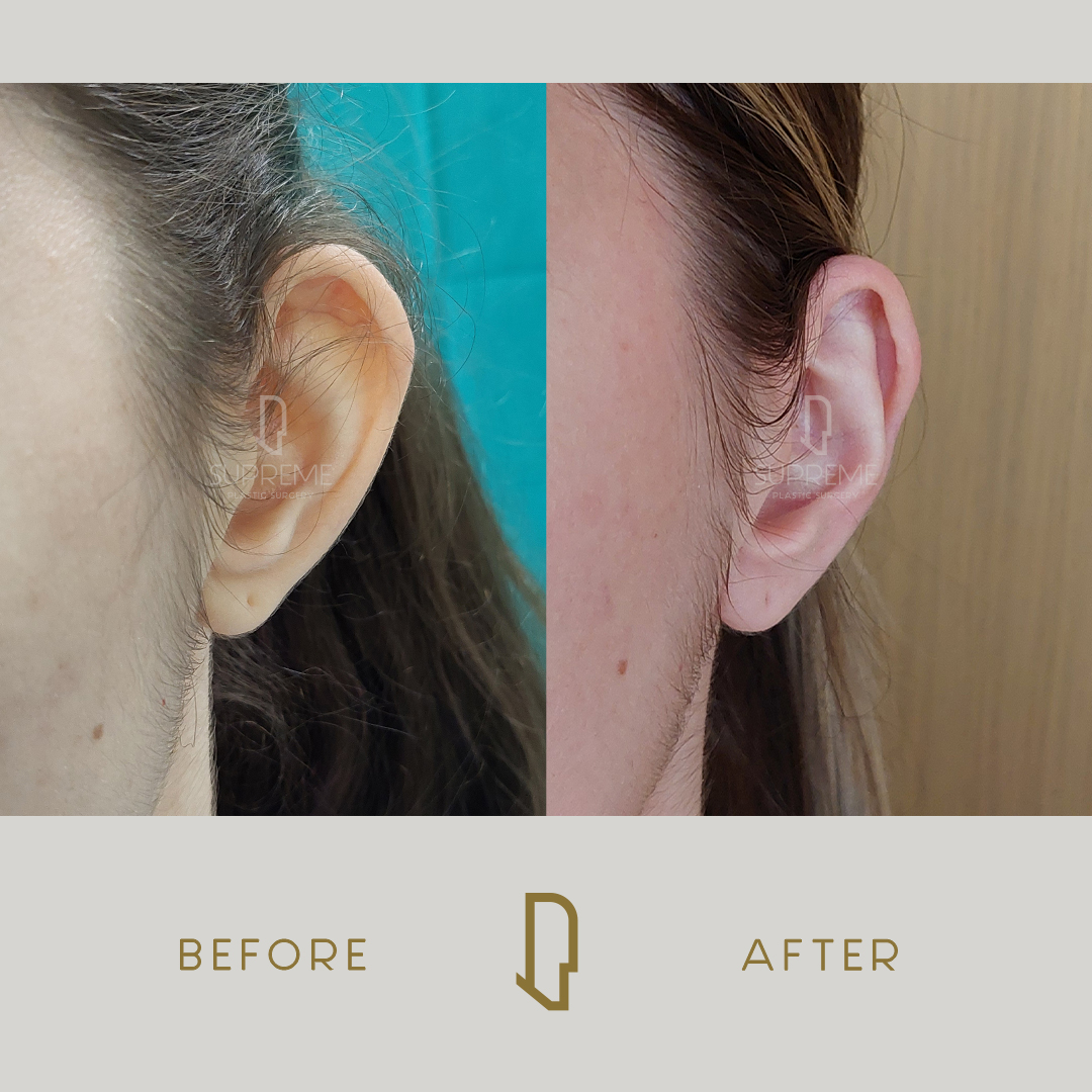 Ωτοπλαστική