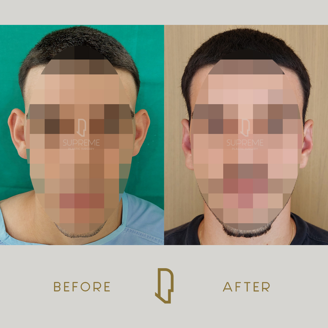 Ωτοπλαστική