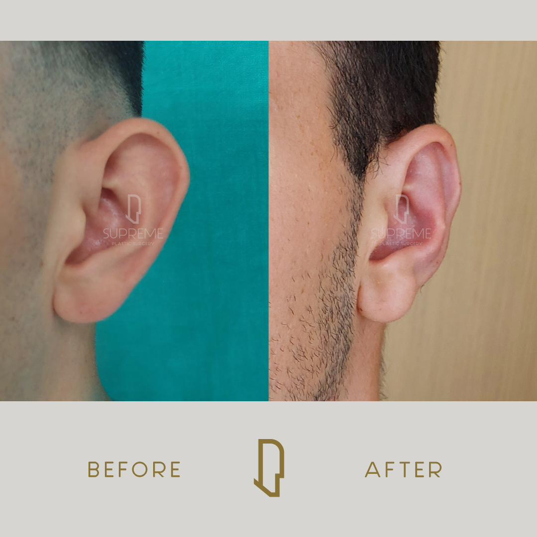 Ωτοπλαστική