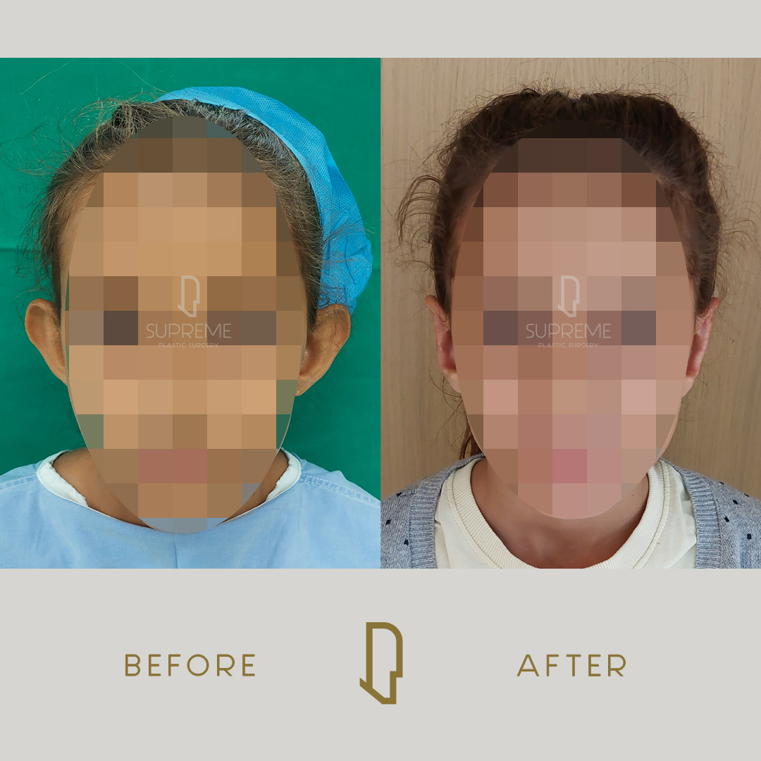 Ωτοπλαστική