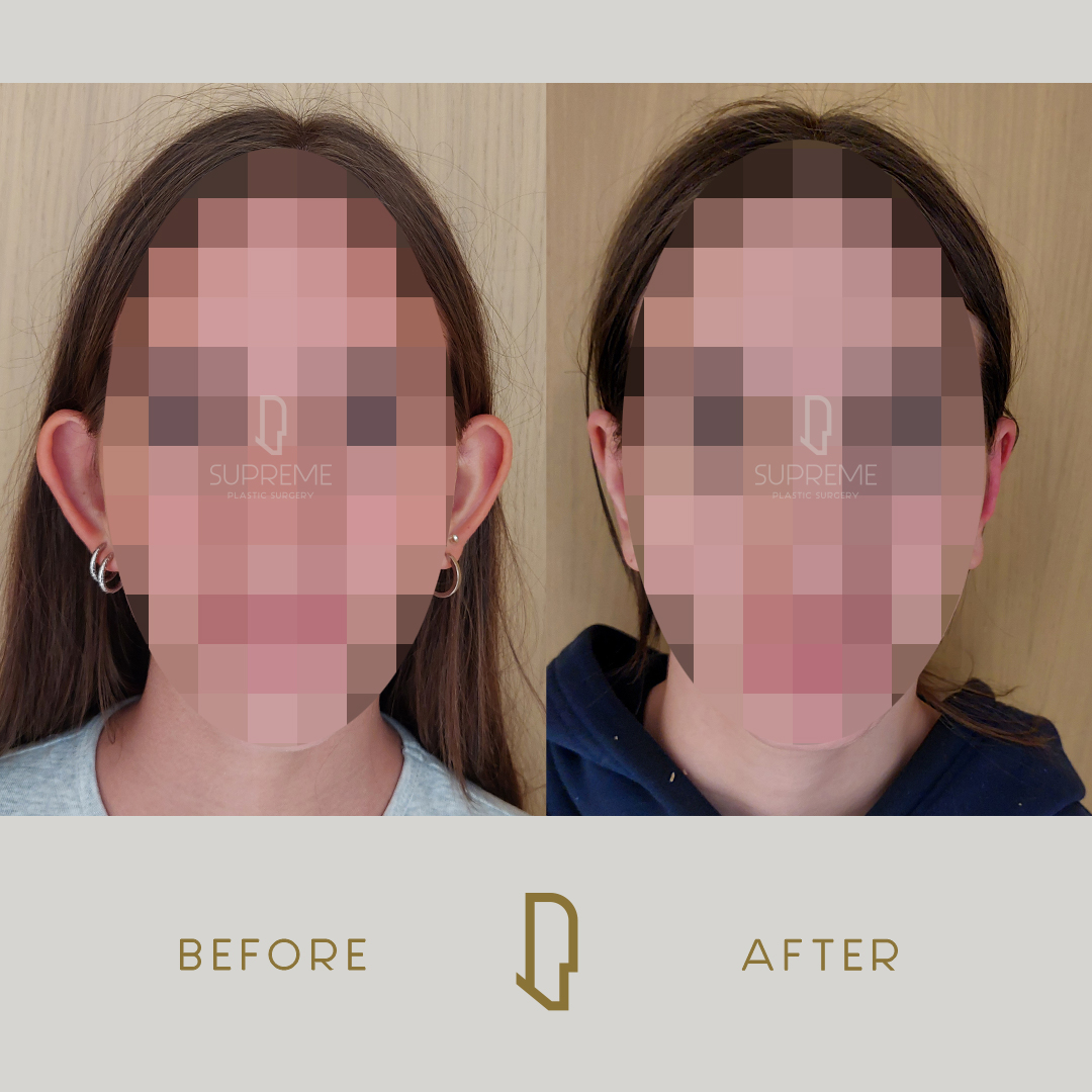 Ωτοπλαστική