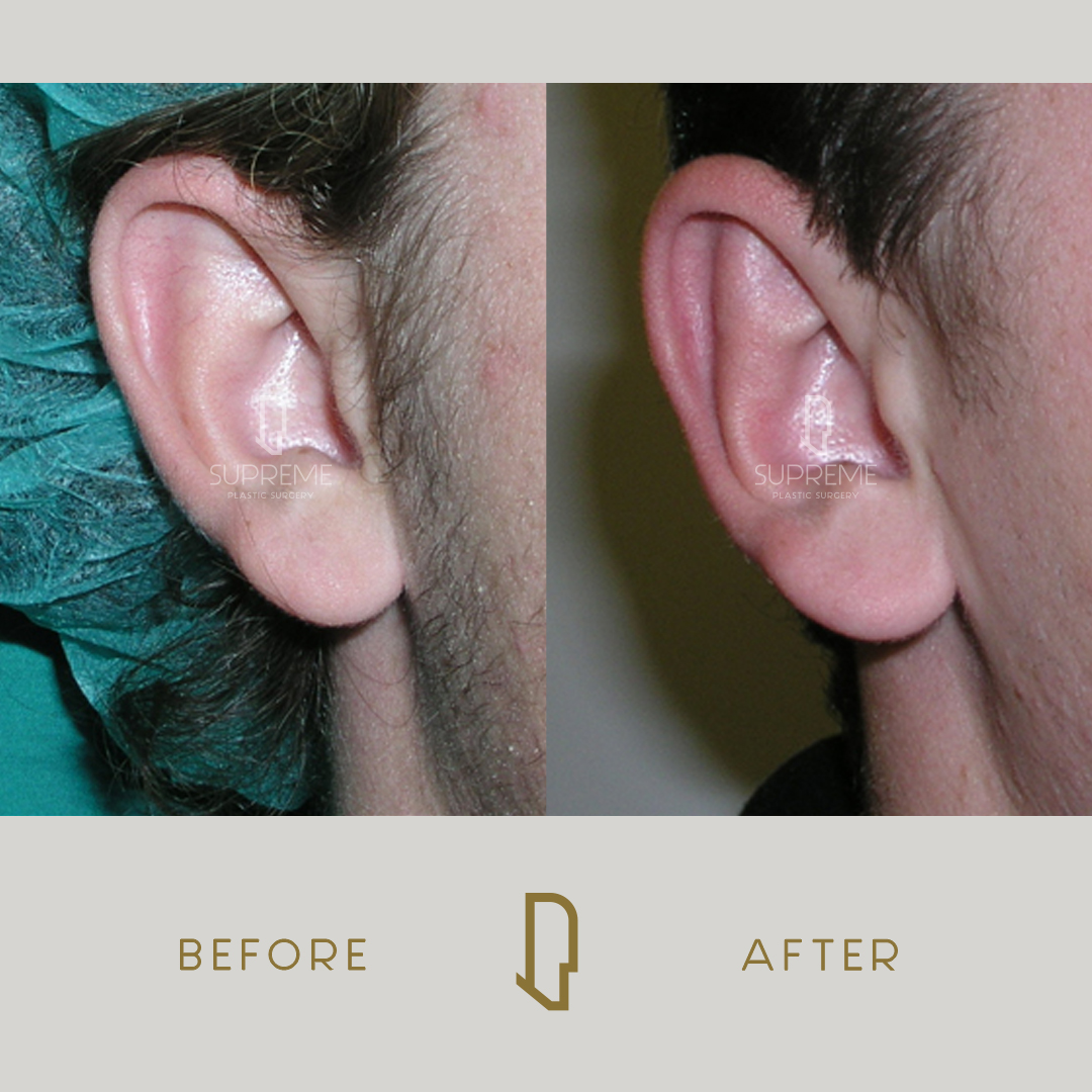 Ωτοπλαστική