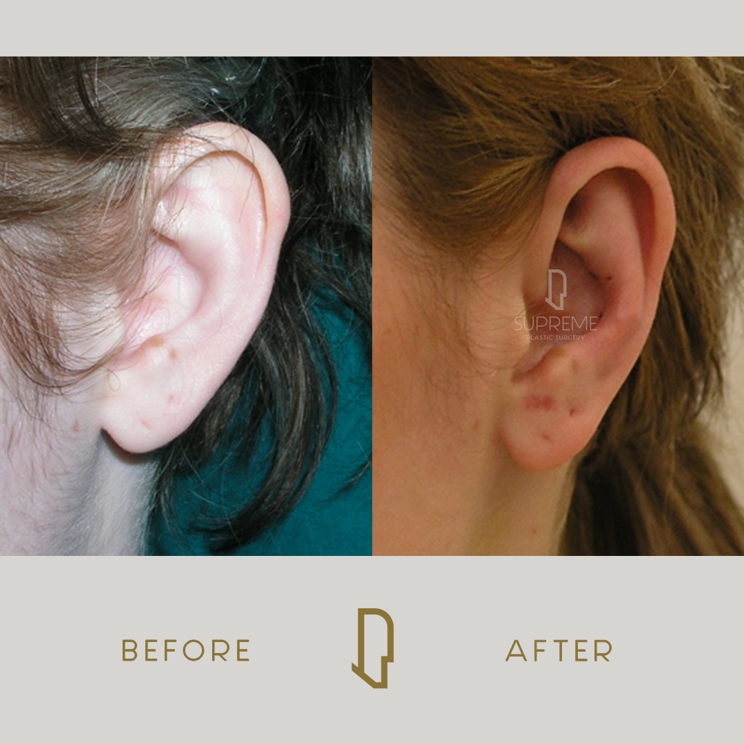 Ωτοπλαστική