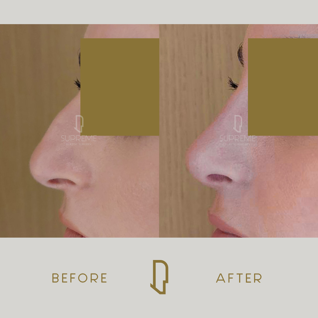 Ρινοπλαστική