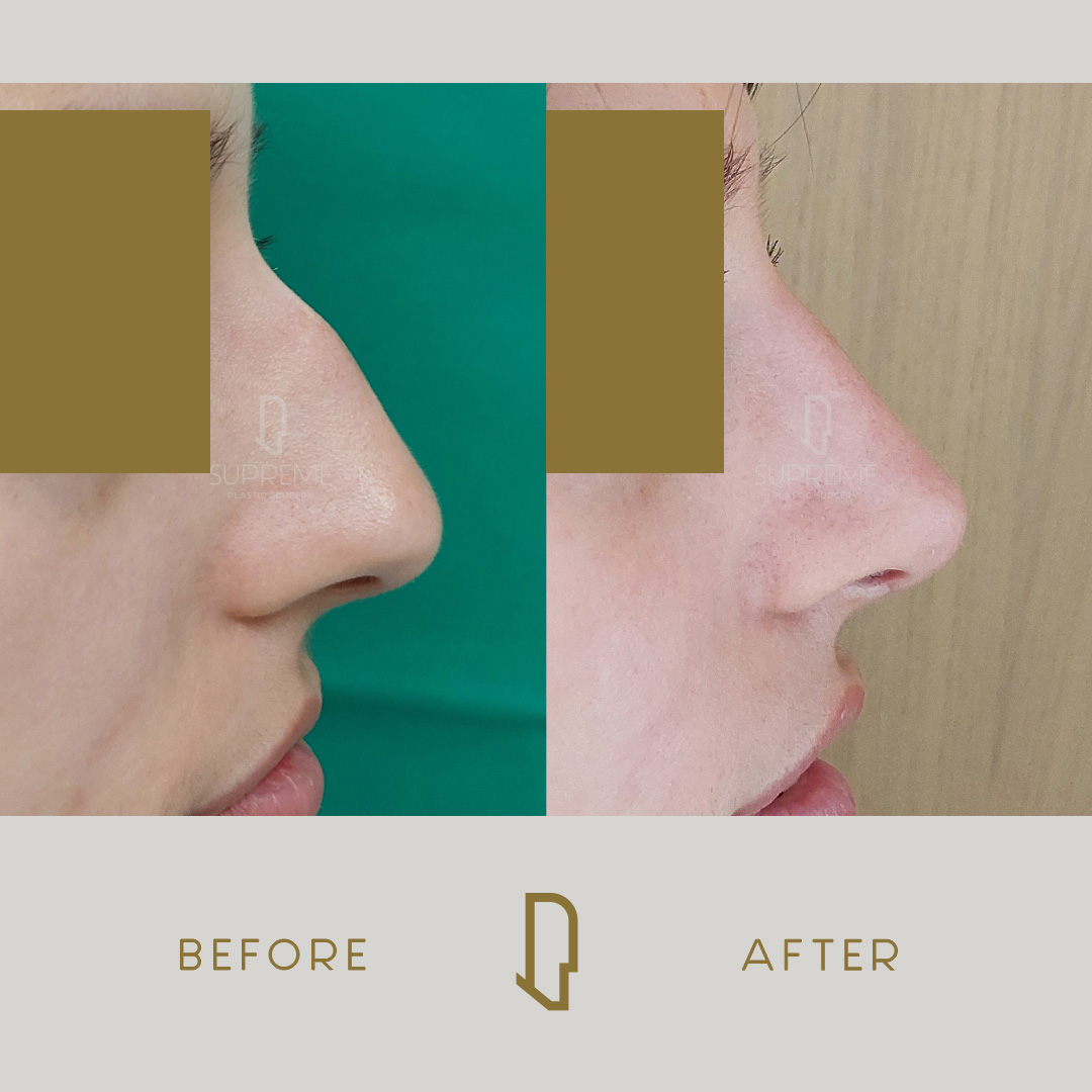 Ρινοπλαστική 