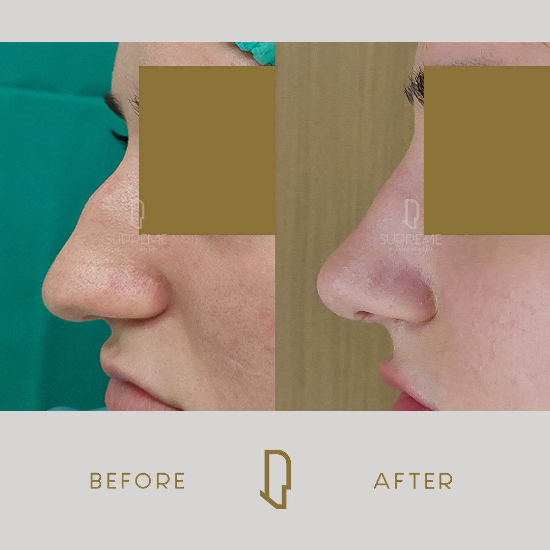 Ρινοπλαστική