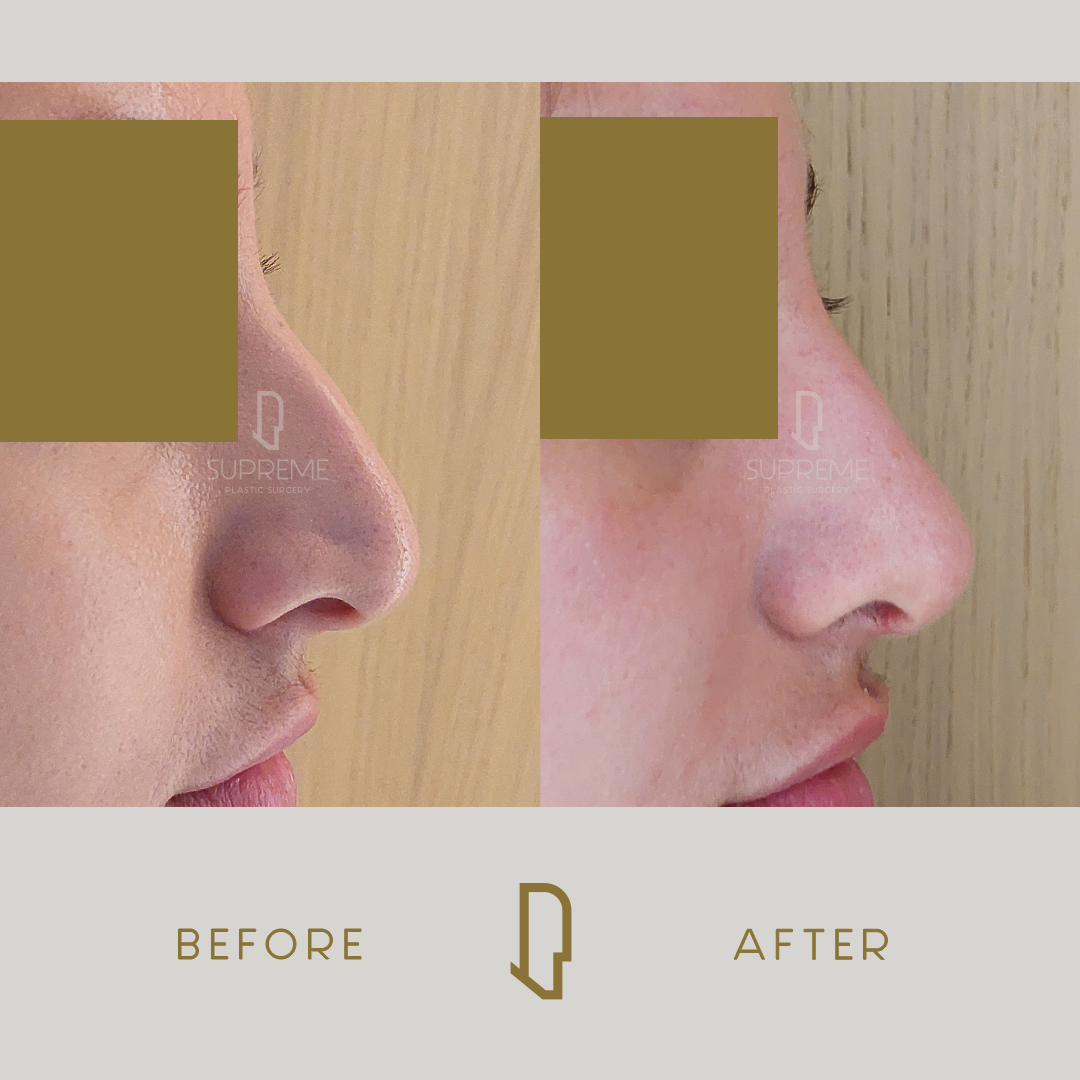 Ρινοπλαστική