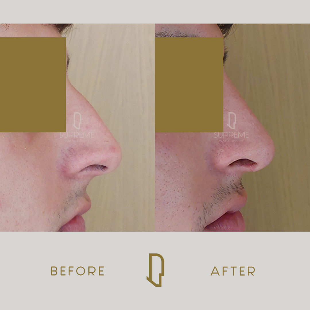 Ρινοπλαστική