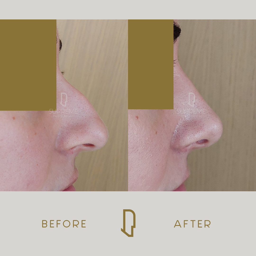 Ρινοπλαστική