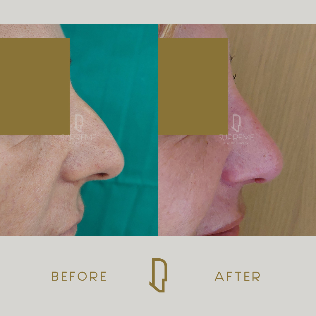 Ρινοπλαστική