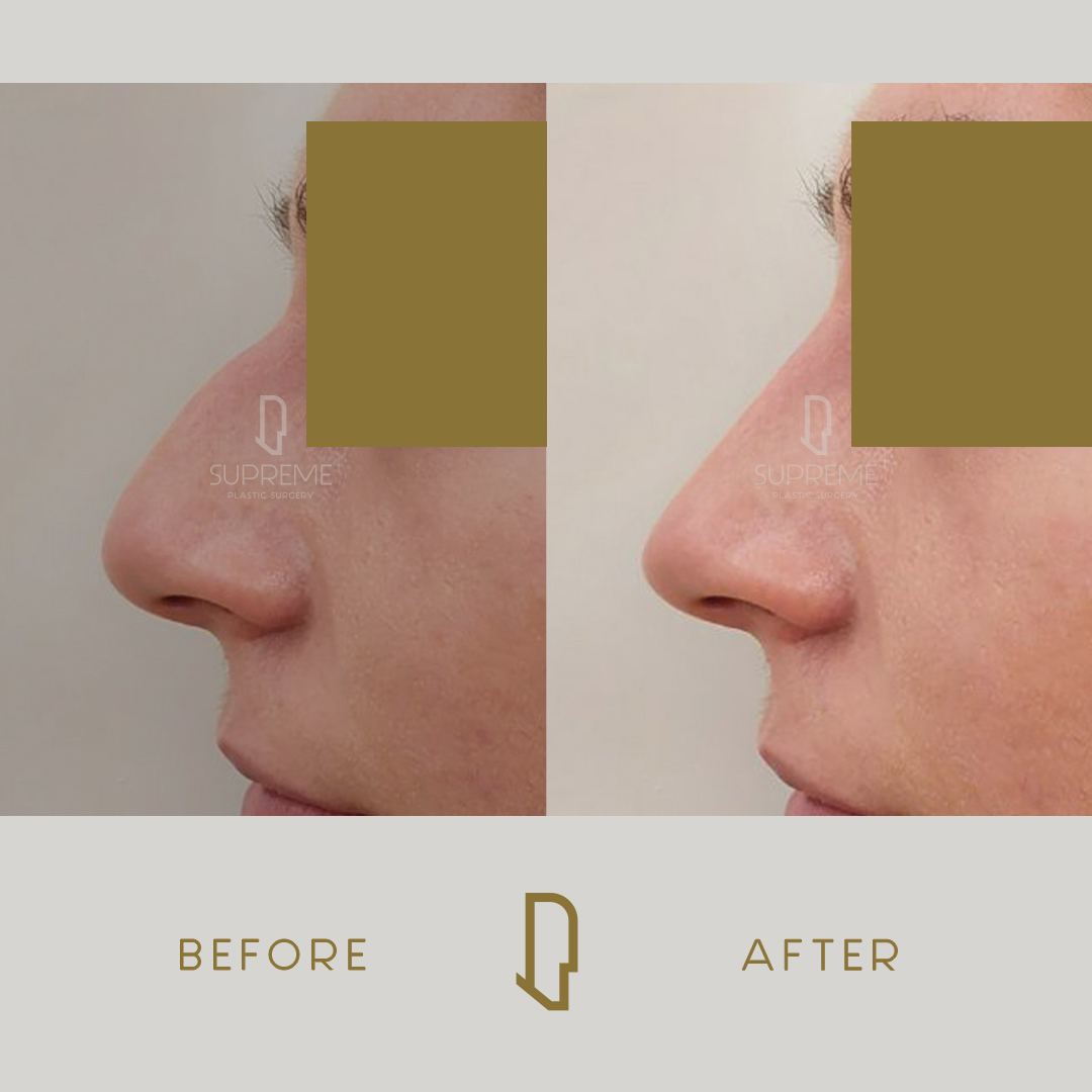 Ρινοπλαστική