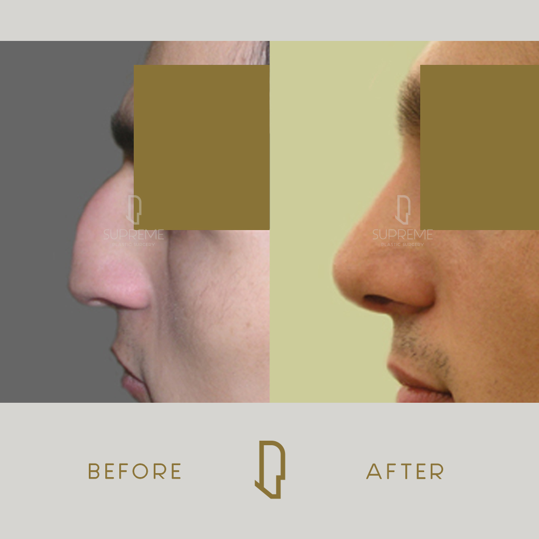 Ρινοπλαστική